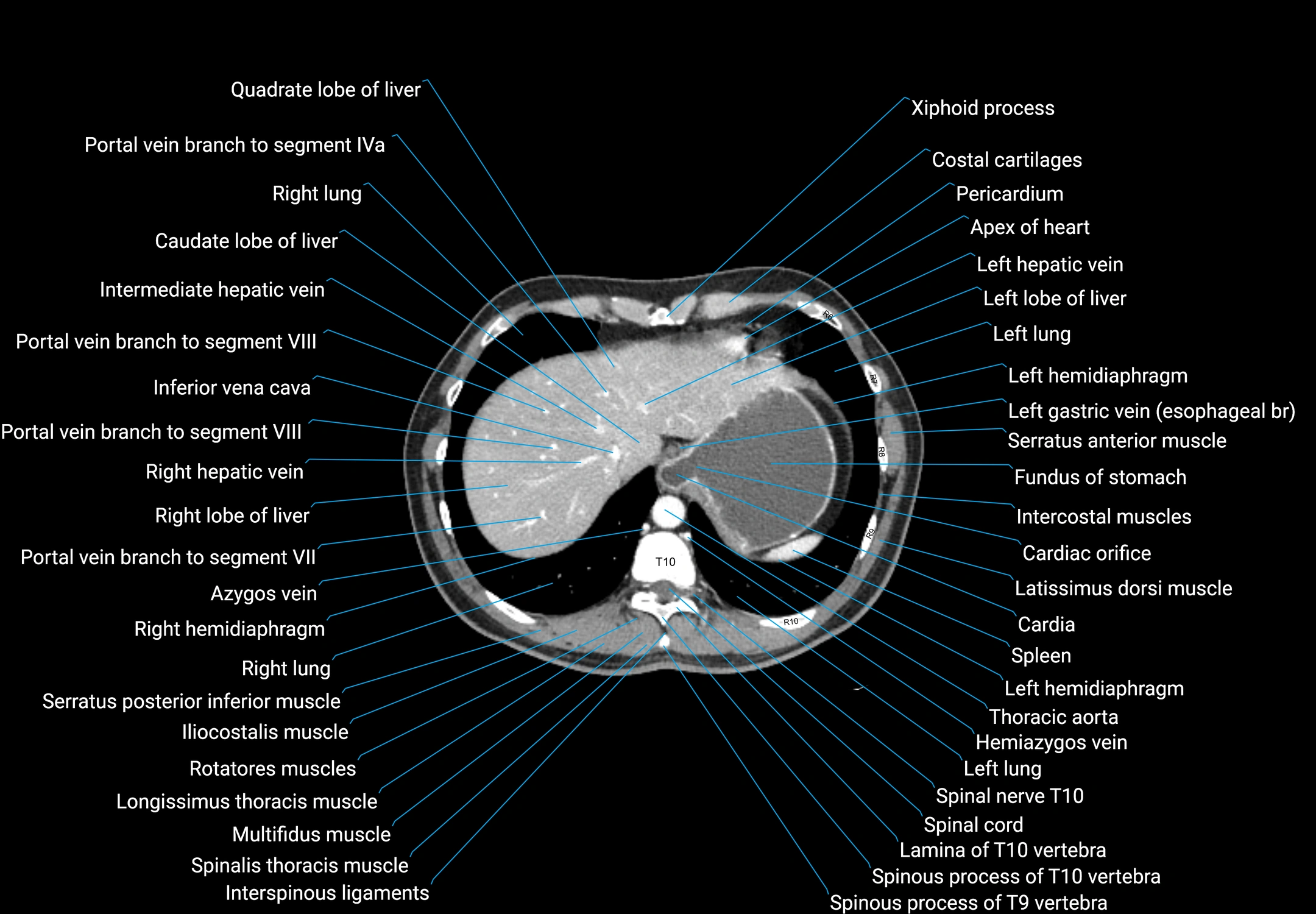 CT male pelvis axial cross sectional anatomy labelled radiology image -00018.webp